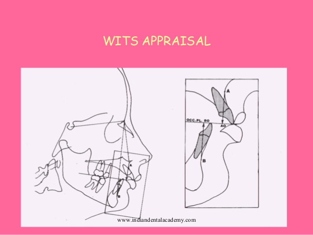 wits appraisal orthodontics